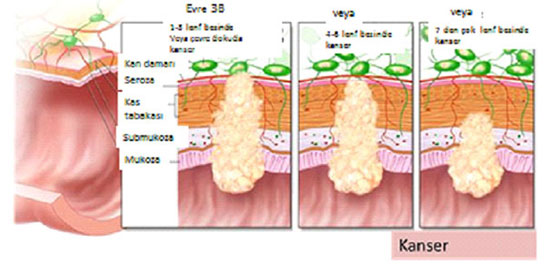 Barsak Kanseri Evreleri
