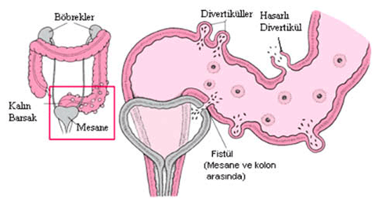 Divertikl