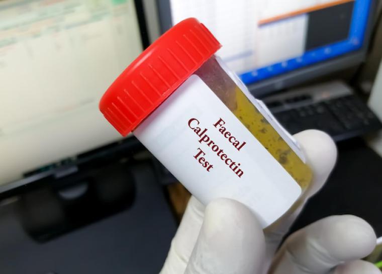 Fekal Kalprotektin (Calprotectin) Testi