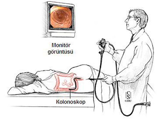 Kolonoskopi