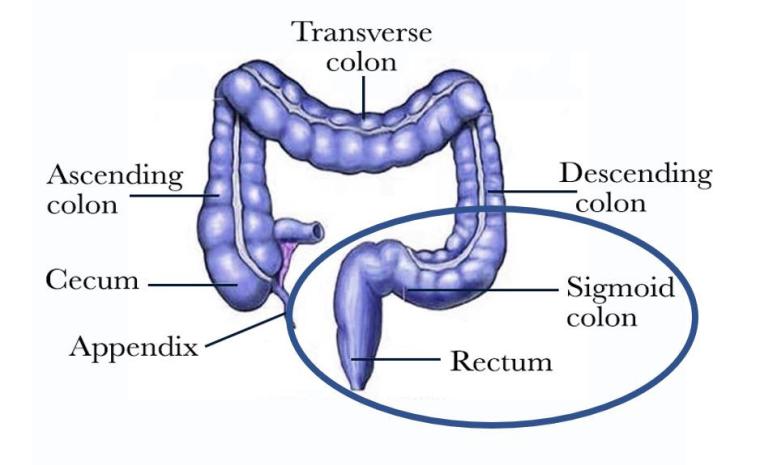 Sigmoid Kolonda Duvar Kalınlaşması Nedir?